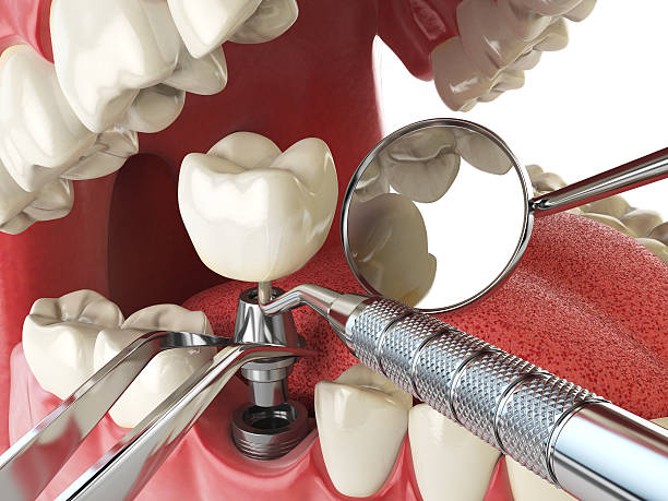 Best Emergency Treatment for Toothache in Bremen, OH